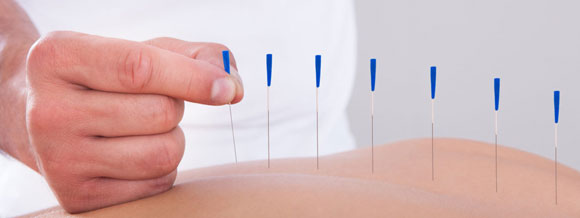 Acupuncture